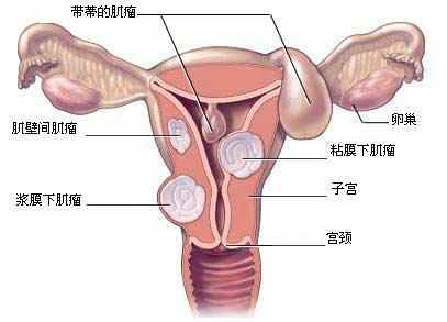 深圳双胞胎借卵医院排名_子宫内膜异位症的症状是什么？
