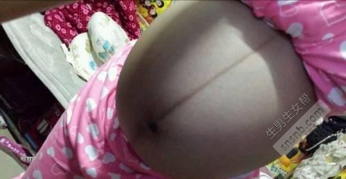 为什么孕妇的肚子上会有一条黑线？如果长成这样，有可能怀上男婴吗？
