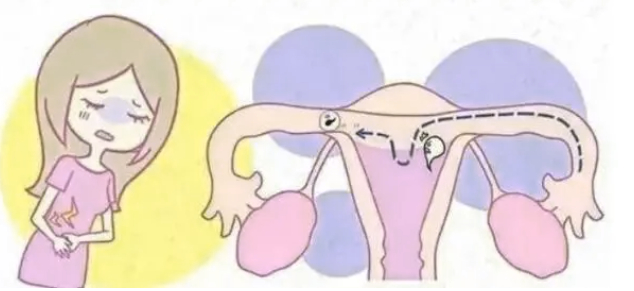 子宫腺肌症不孕症引起的痛经可以做试管婴儿吗？
