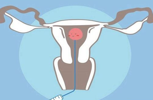 保定助孕生子多少钱：为什么最高的成功率与三代试管婴儿（IVF）的好处有关。