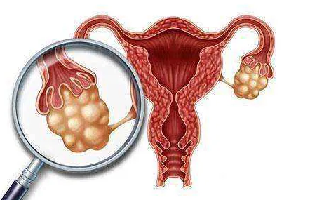 衡阳供卵试管成功率-女性的卵巢囊肿会影响第三代试管婴儿的成功率吗？