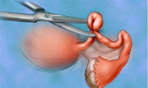 淄博借卵试管女孩-一些医生建议妇女在做试管婴儿前先把输卵管钳住，而在钳住输卵管的情况下做试管婴儿还有这些好处
